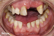 Dental Bridge Before After Pictures